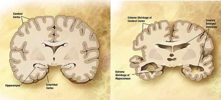 alzheimer_cerveau